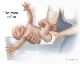 Moro Reflex